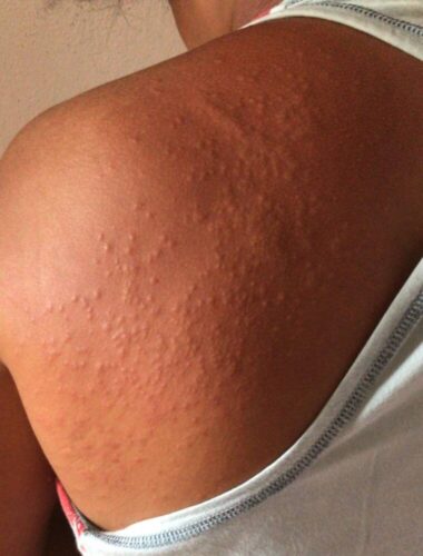 Surto de lesões que causam coceira na pele é investigado no Recife; 79 pessoas tiveram sintomas.