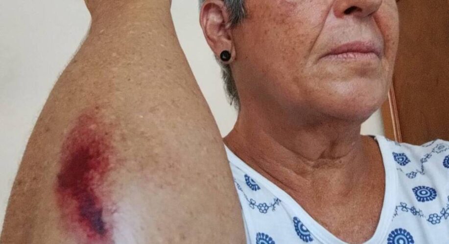 Funcionária pública aposentada é agredida em assalto quando pedalava no Centro do Recife